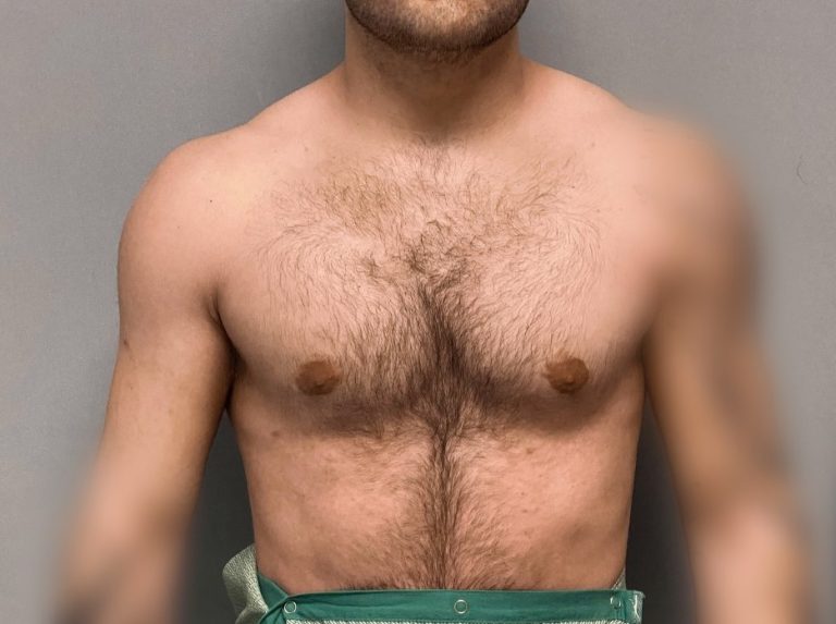 Plastic Surgery Case Study Upper Arm Muscle Enlargement with