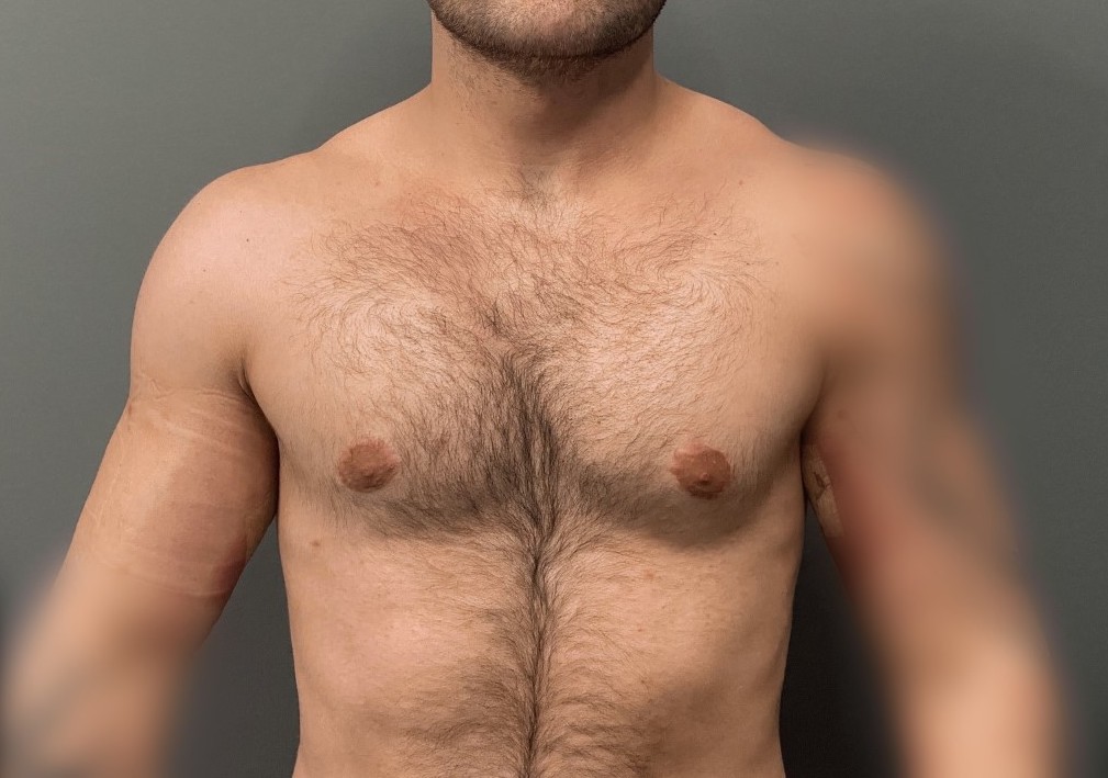 Plastic Surgery Case Study Upper Arm Muscle Enlargement with Submuscular Bicep and Subfascial