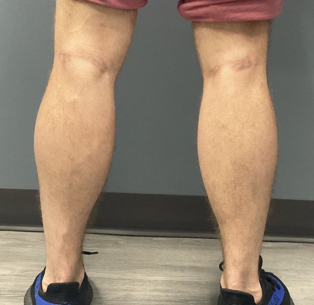 Plastic Surgery Case Study The Four Calf Implant Approach for