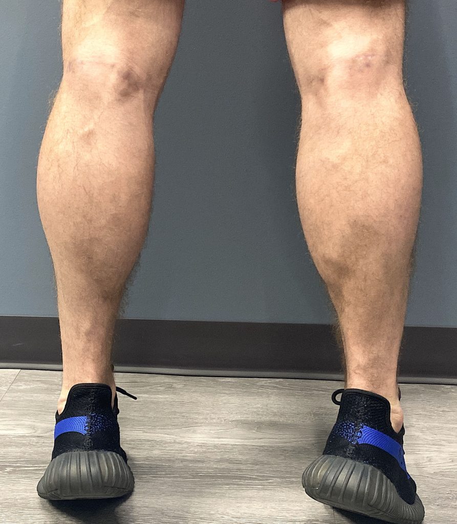 Plastic Surgery Case Study The Four Calf Implant Approach for