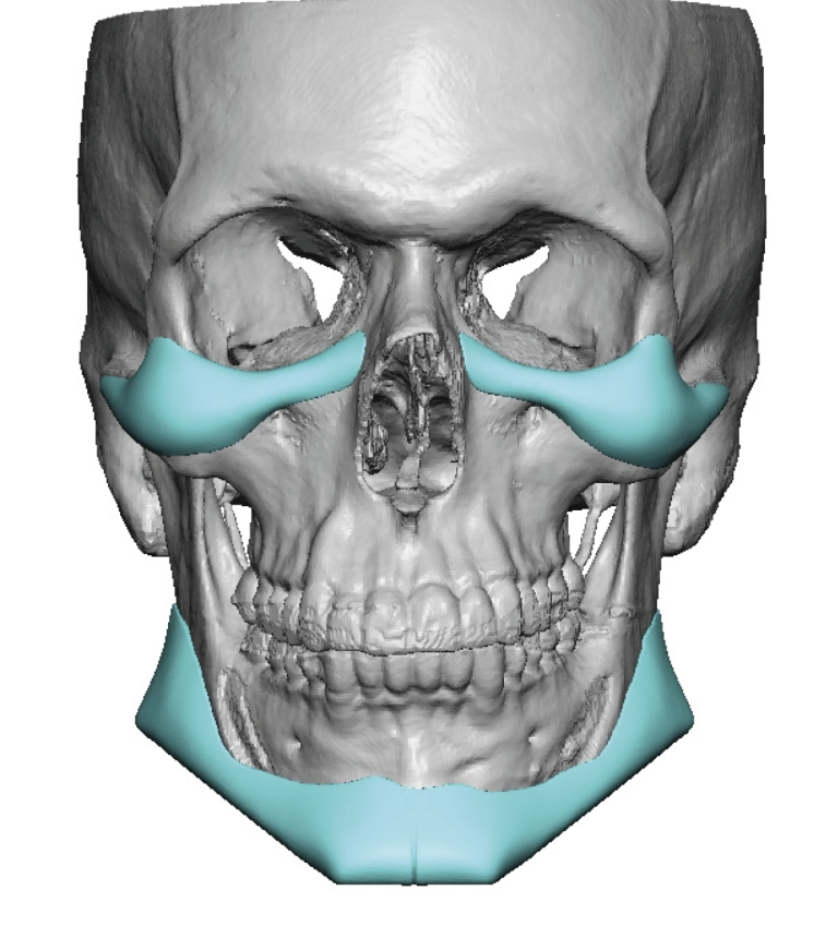 Plastic Surgery Case Study - Custom Jawline Implant Replacement For A ...