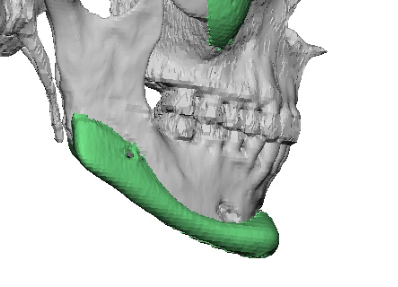 Plastic Surgery Case Study - Secondary Custom Chin and Jaw Angle ...