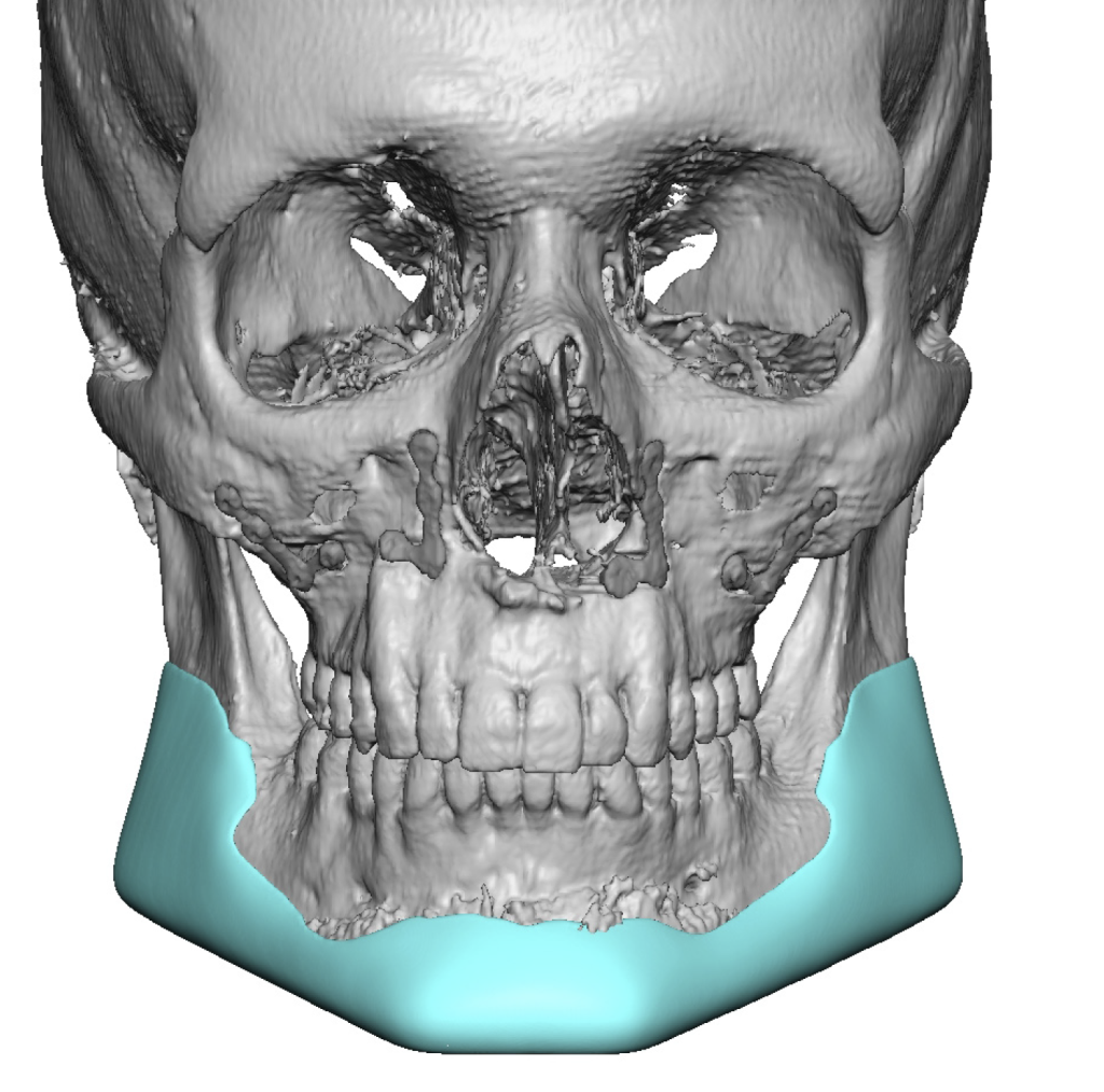 Plastic Surgery Case Study - Custom Jawline Implant Decision Over Bimax ...