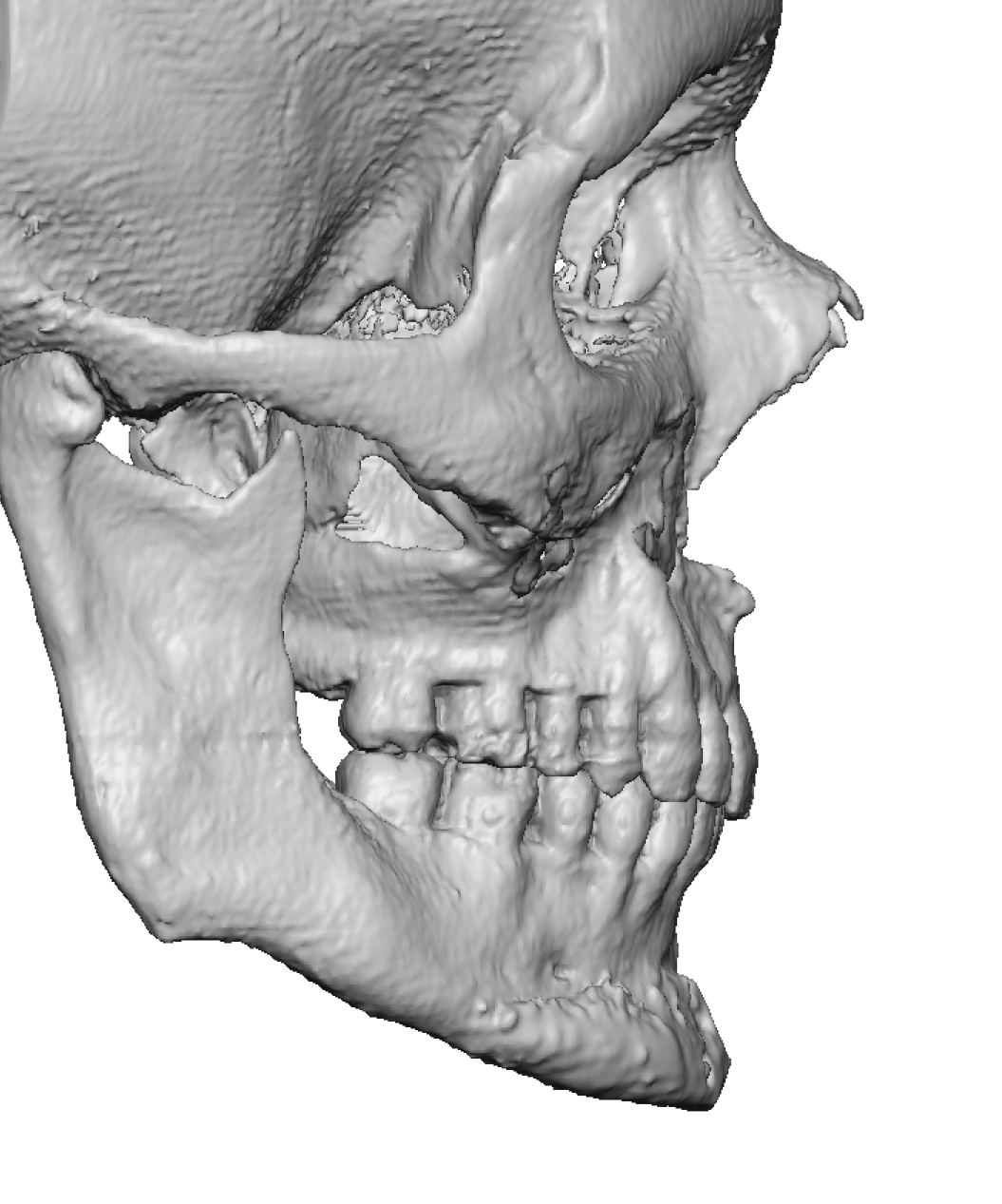 male jawline implant side 1 Dr Barry Eppleuy - Explore Plastic Surgery