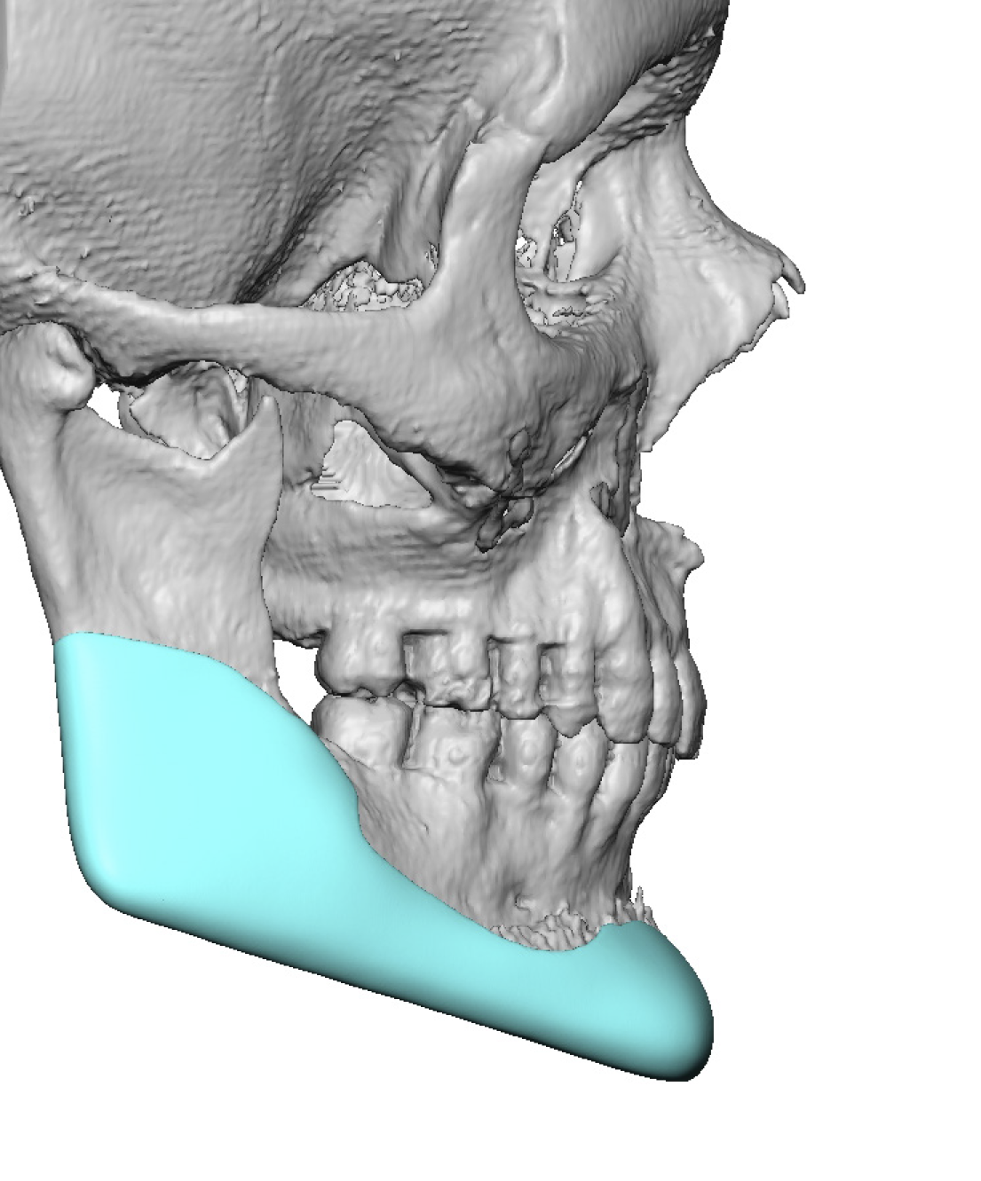 Plastic Surgery Case Study - Custom Jawline Implant Decision Over Bimax ...