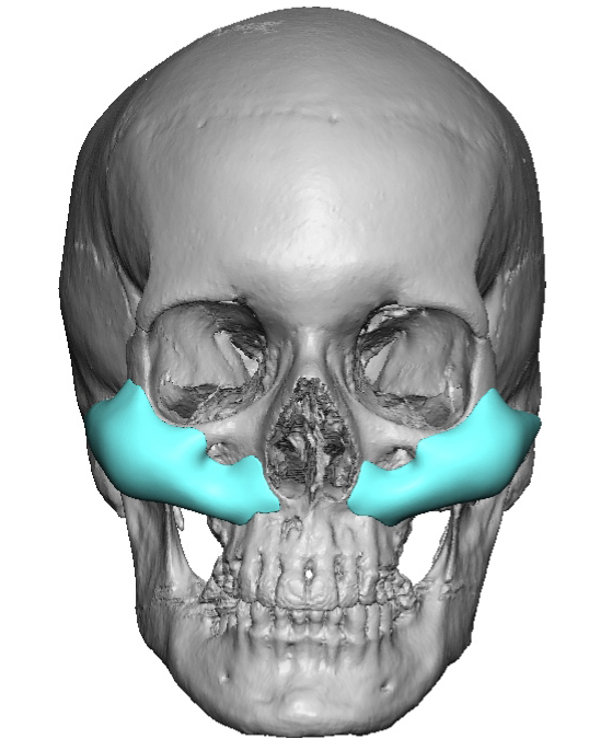 Plastic Surgery Case Study - Increasing Midface Projection and Lift ...