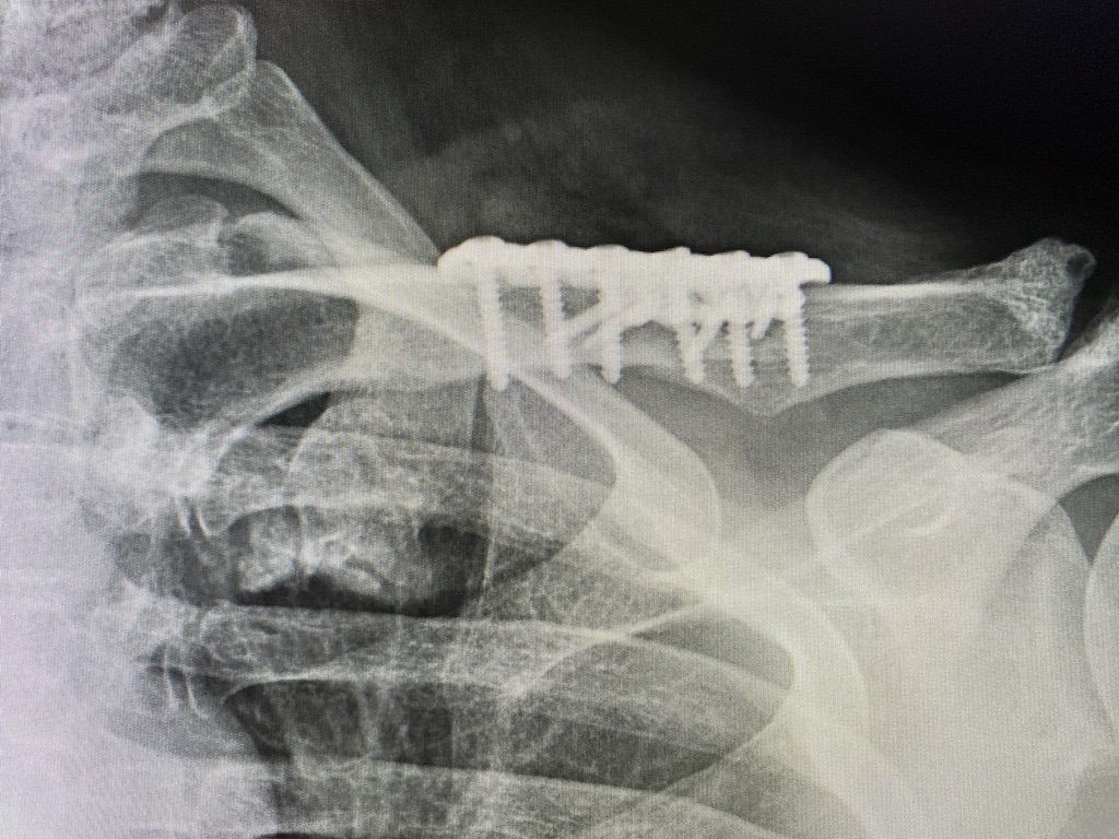 Technical Strategies Single vs Double Plate Fixation in Clavicle