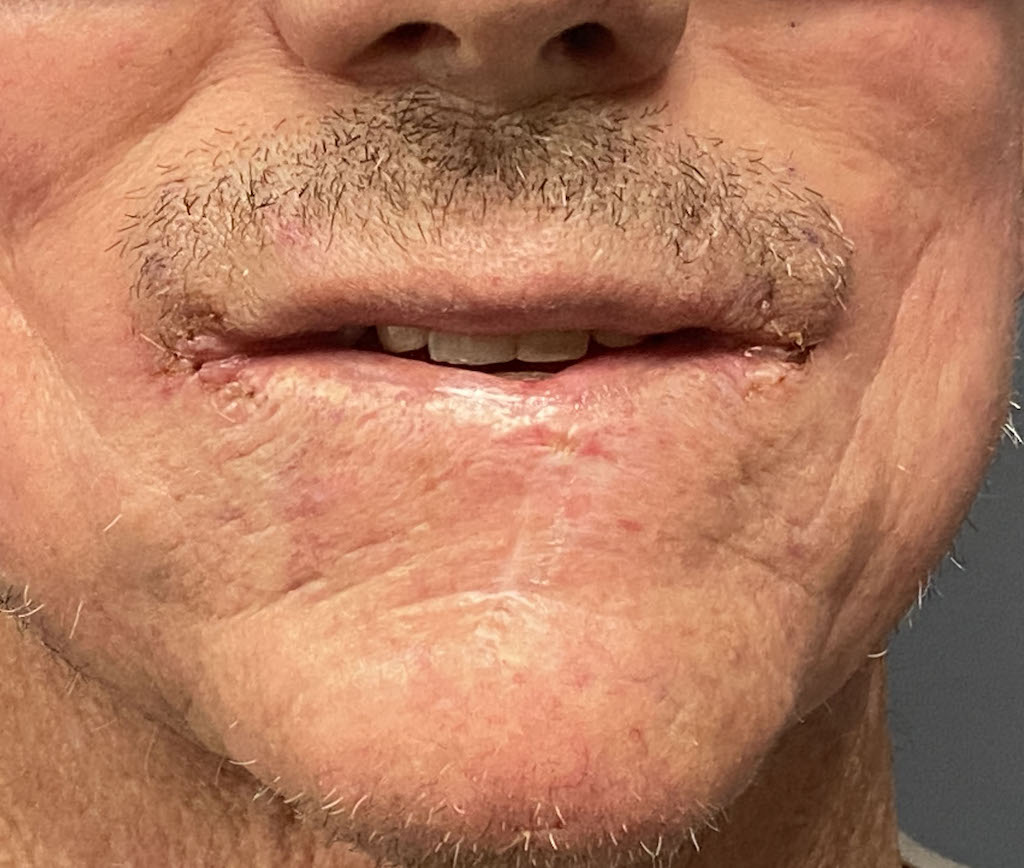 male mouth widenng after lip reconstruction front 2 Dr Barry Eppley