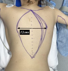 Plastic Surgery Case Study - The Vertical Backlift for Waistline