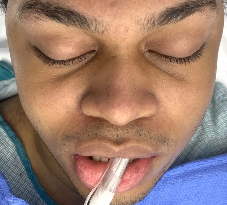 Plastic Surgery Case Study Three Level Soft Tissue Cheek Reduction