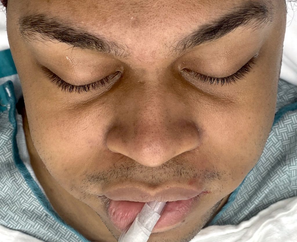 Plastic Surgery Case Study Three Level Soft Tissue Cheek Reduction