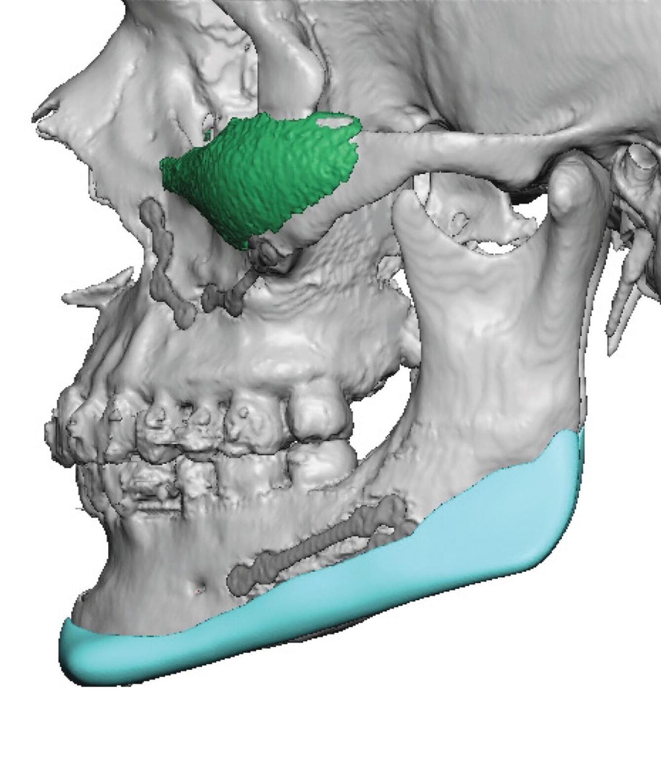 Plastic Surgery Case Study - Custom Jawline Implant Refinement after ...