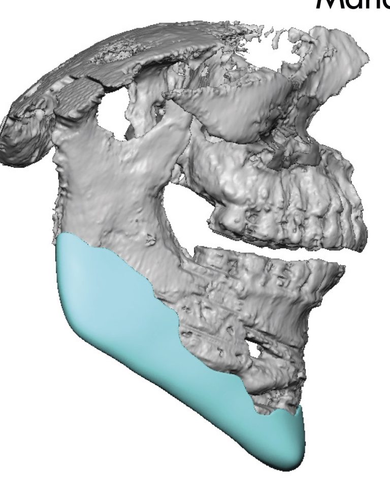 Plastic Surgery Case Study - Custom Jawline Implant after Extreme ...