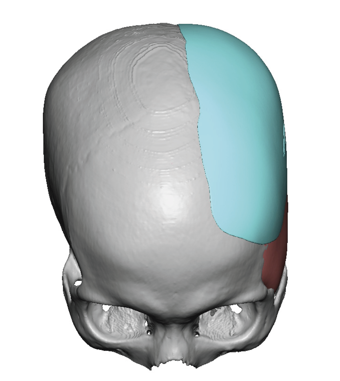 Custom Skull Implant For Left Lop Sides Head Shape Design Top View Dr