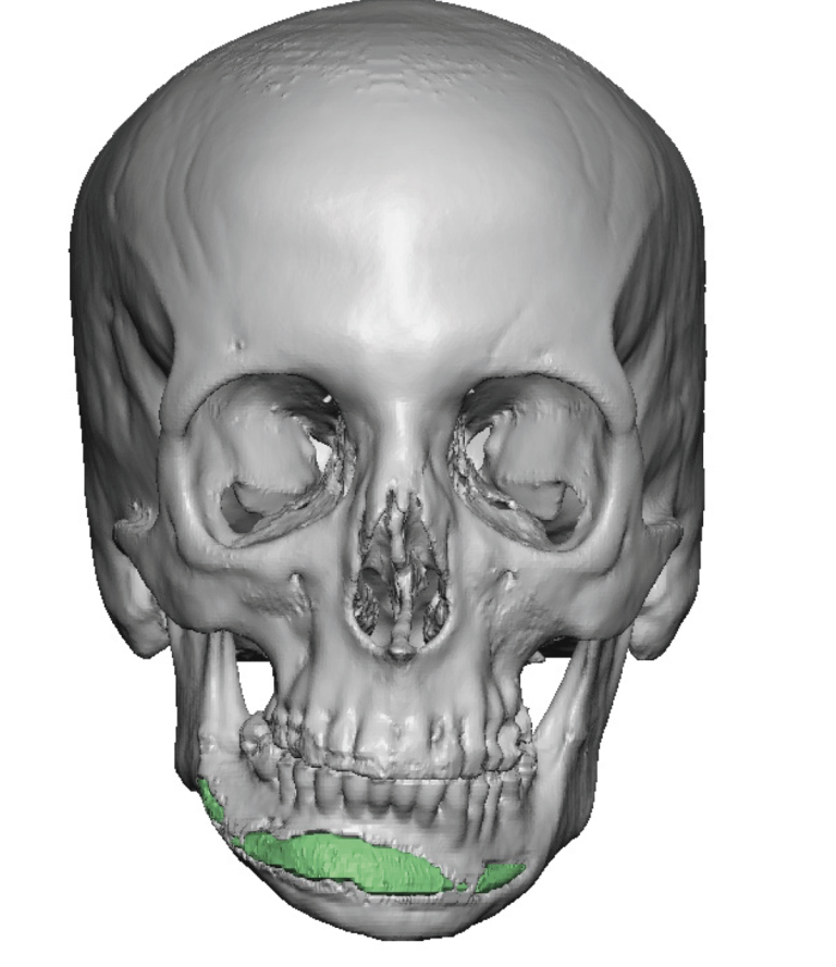 Plastic Surgery Case Study - Custom Female Infraorbital-Malar and ...