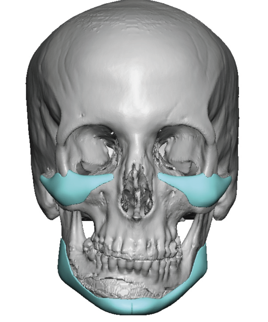 Plastic Surgery Case Study - Custom Female Infraorbital-Malar and ...