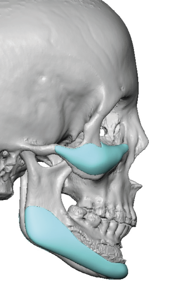 Plastic Surgery Case Study - Custom Female Infraorbital-Malar and ...