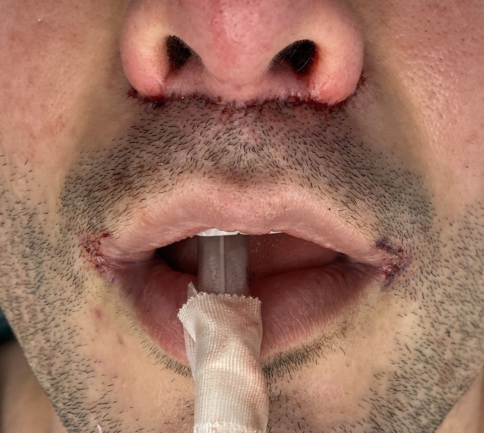 male subnasal lip and corner of mouth lifts 2 Dr Barry Eppley - Explore  Plastic Surgery