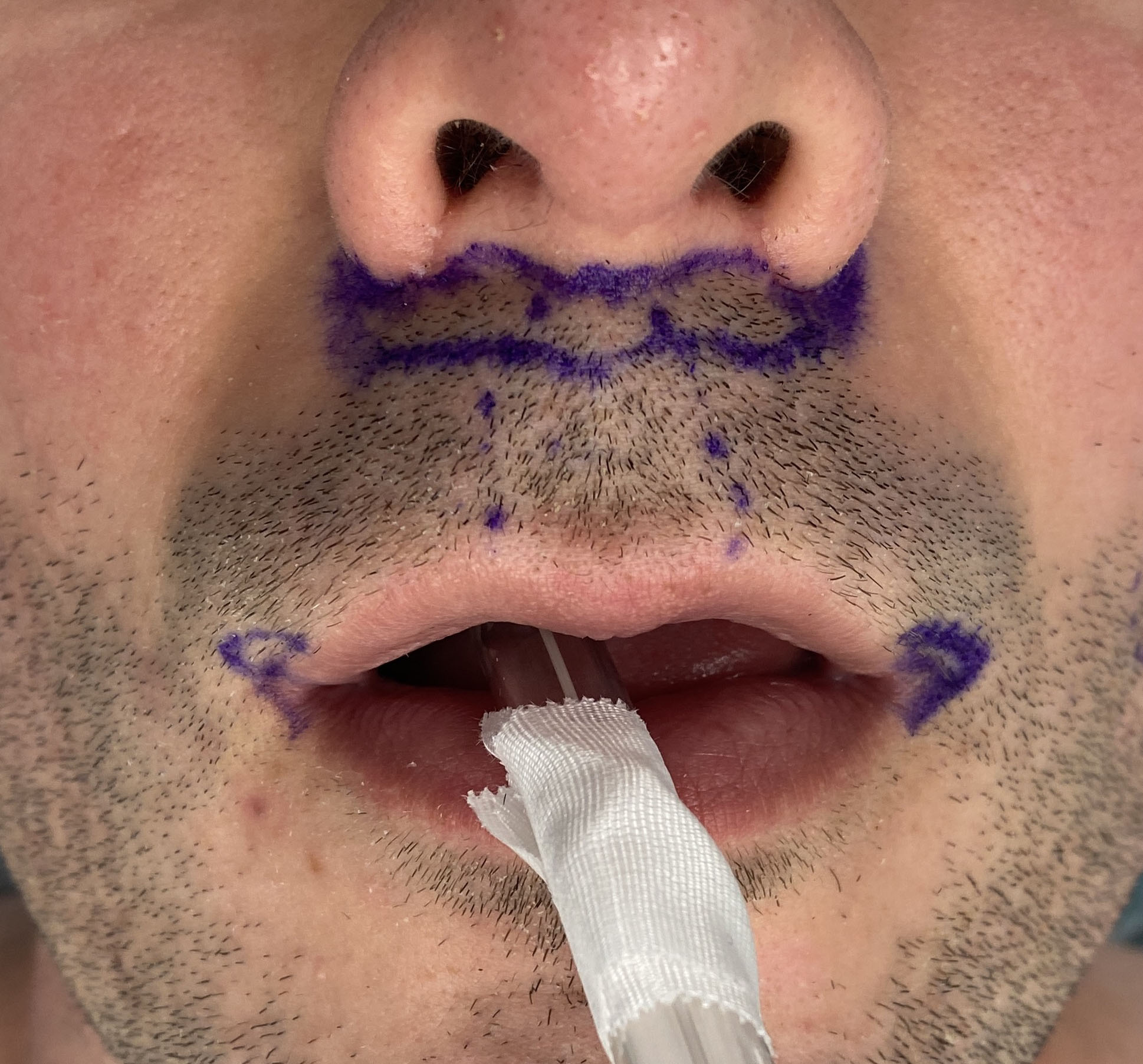 Technical Strategies Male Upper Lip Enhancement with Subnasal Lip