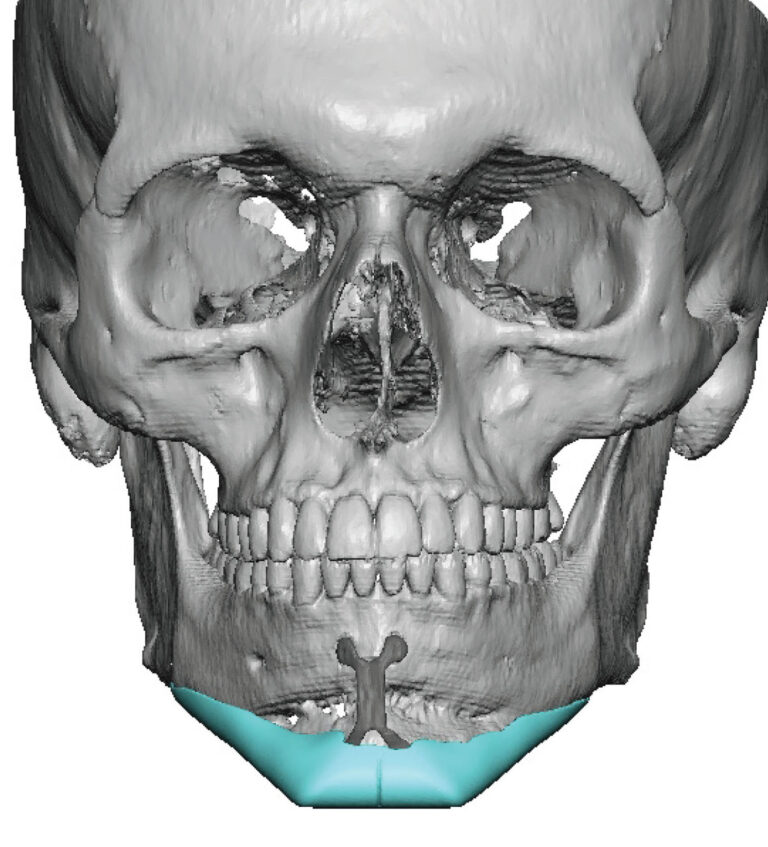 Plastic Surgery Case Study - Extended Custom Chin Implant after ...