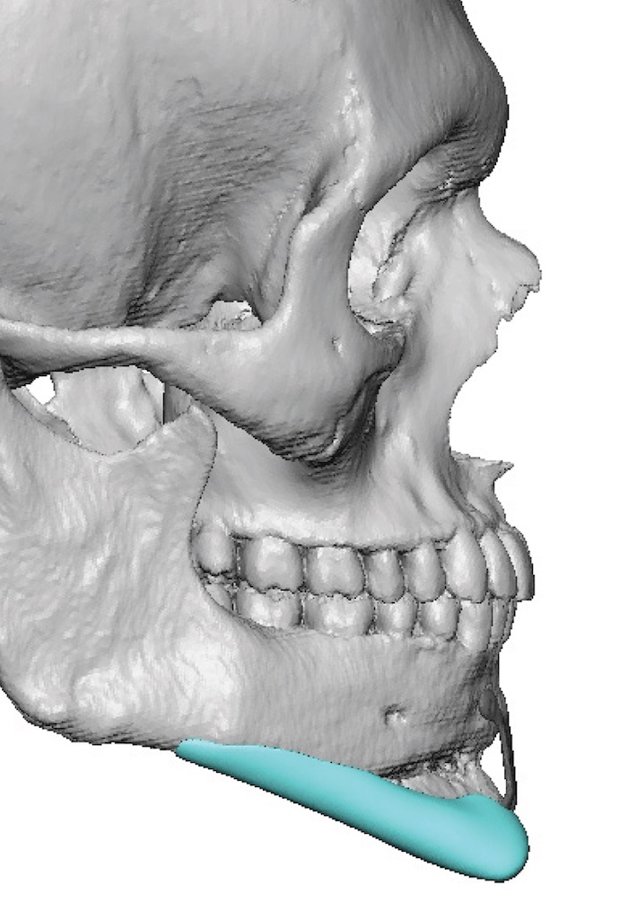 Plastic Surgery Case Study - Extended Custom Chin Implant after ...