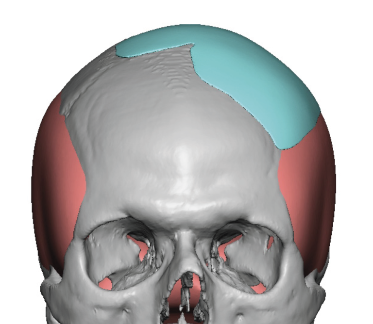 Plastic Surgery Case Study - Long Term Scalp Scar Outcome in Custom ...