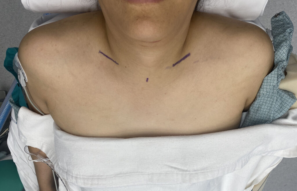 plastic-surgery-case-study-clavicle-bone-size-differences-across-the