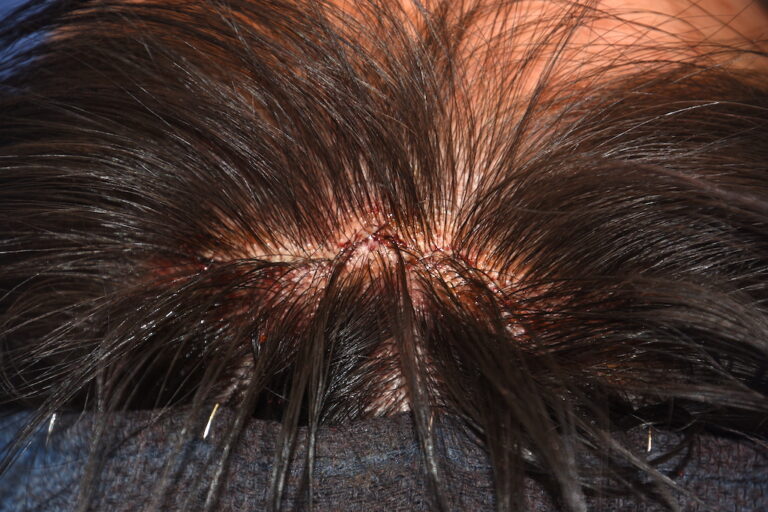 Forehead Implant Scalp Incision Closure Dr Barry Eppley Explore