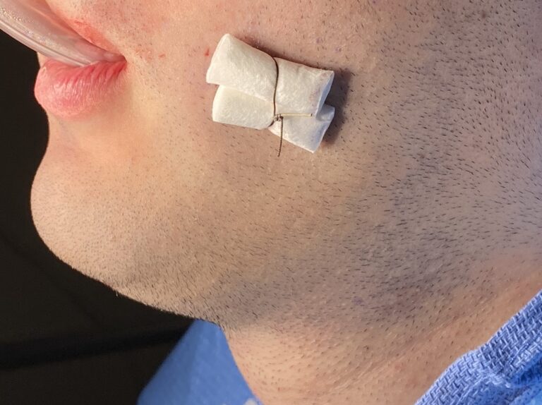 Technical Strategies Bolster Dressing for Buccinator Myectomies and