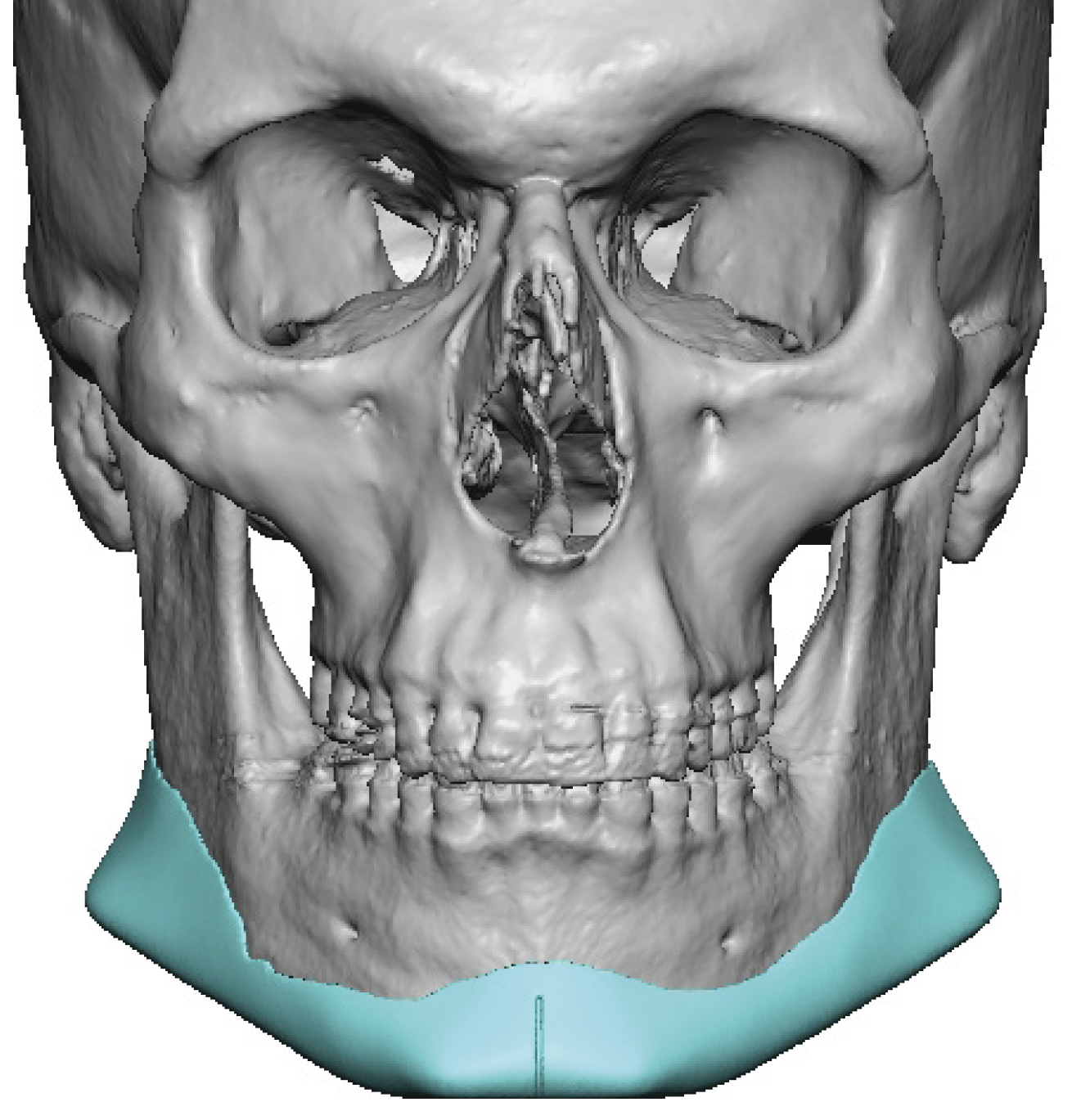 Technical Strategies - The First Step in Intraioperative Positioning of ...