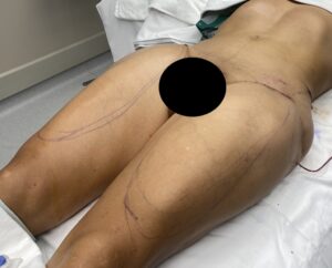 Plastic Surgery Case Study - Custom Thigh Implant Replacements - Explore  Plastic Surgery