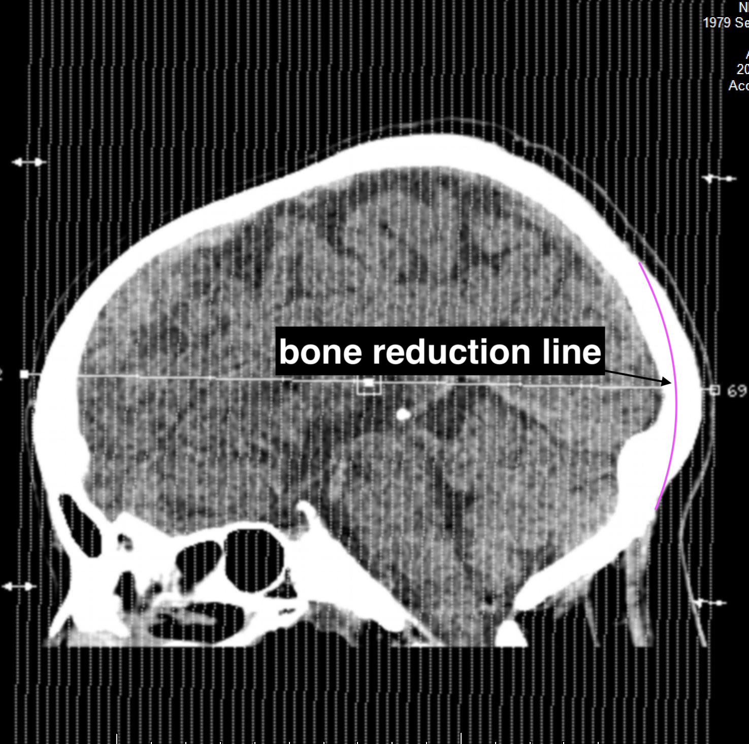 Plastic Surgery Case Study Male Occipital Bun Skull Reduction