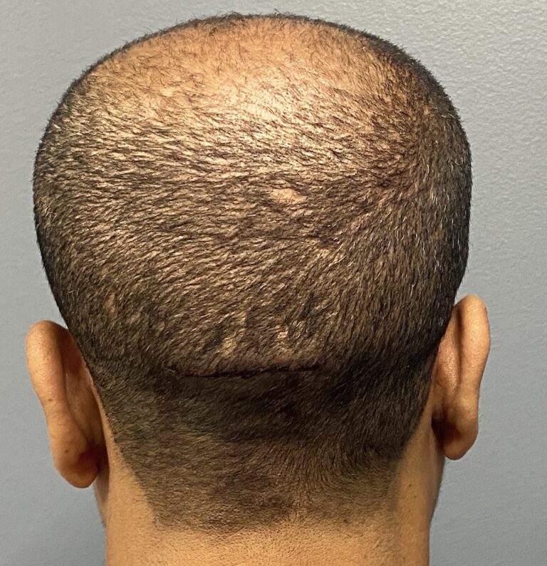 Plastic Surgery Case Study - Male Occipital Bun Skull Reduction ...