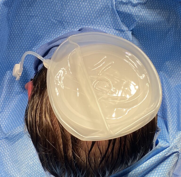 1st Stage Scalp Expander Placement for Large Custom Skull Implants