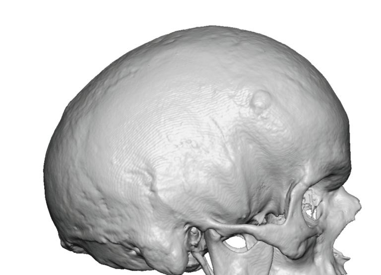 Plastic Surgery Case Study - Custom Two-Piece Skull Implant for Adult ...