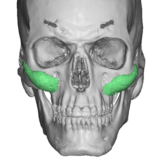 Technical Strategies - Treating The Cheek Implant Stepoff Deformity 