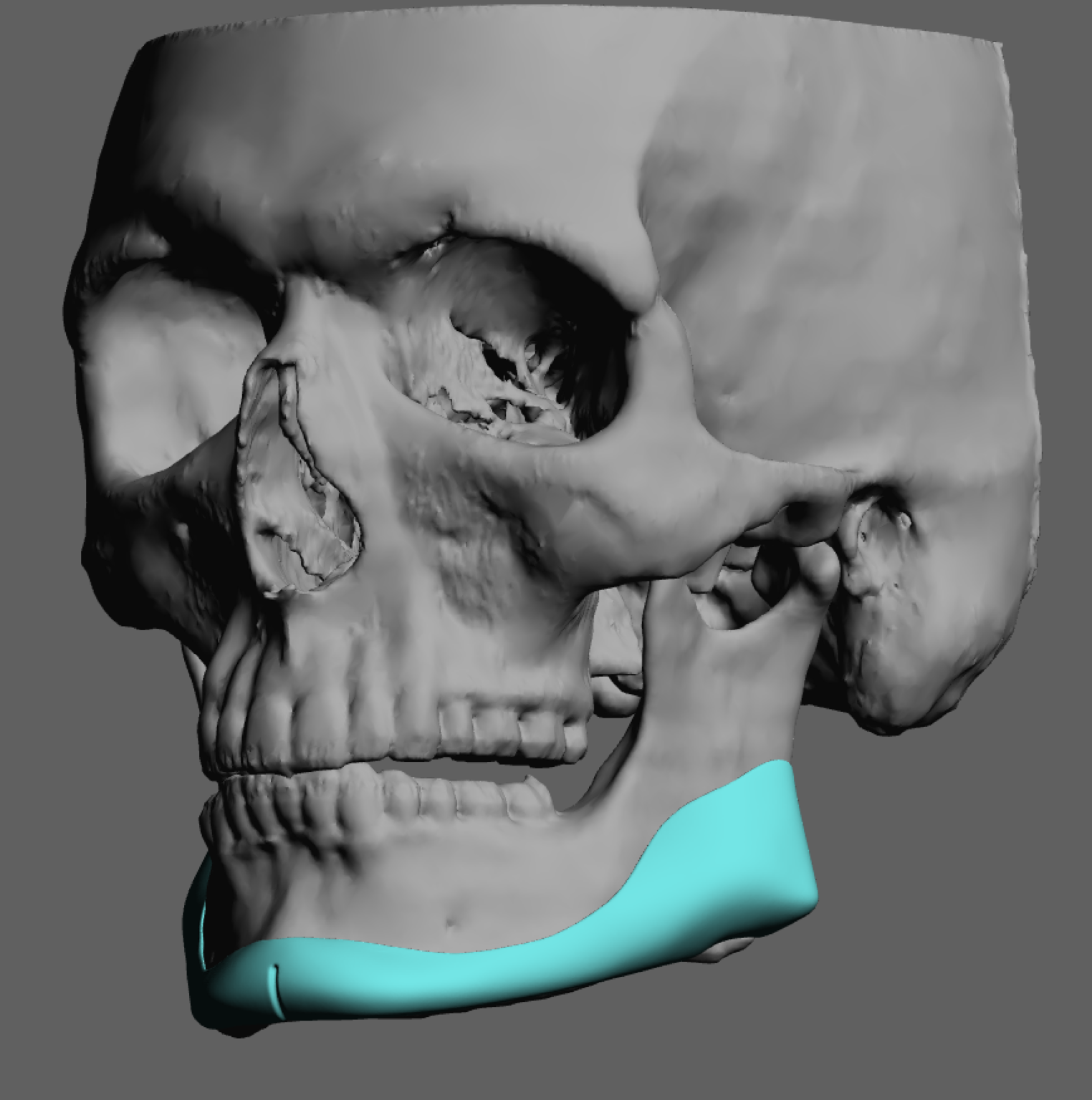 Plastic Surgery Case Study - Custom Jawline Implant Design with ...