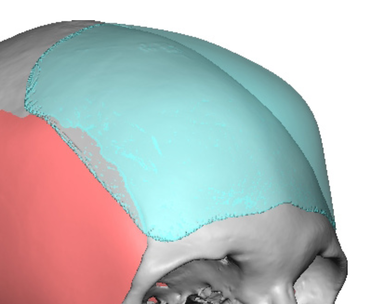 Plastic Surgery Case Study Custom Forehead Implant for Improving the