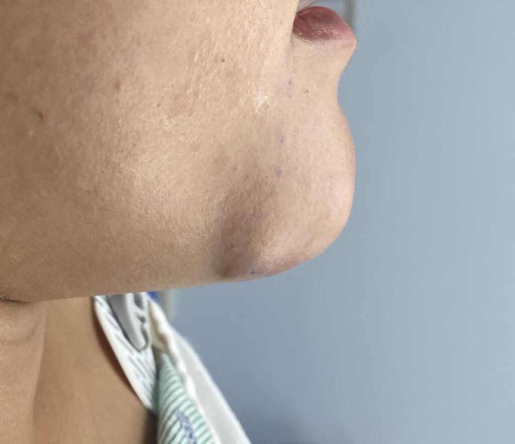Plastic Surgery Case Study - Submental Excision/Tuck for Hyperdynamic ...