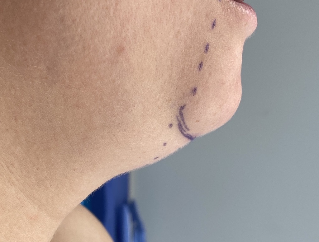 Plastic Surgery Case Study Submental Chin Pad Excision And Tuck For Hyperdynamic Ptosis