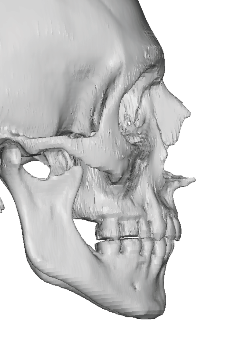 Plastic Surgery Case Study - Large Custom Infraorbital-Malar Implants ...