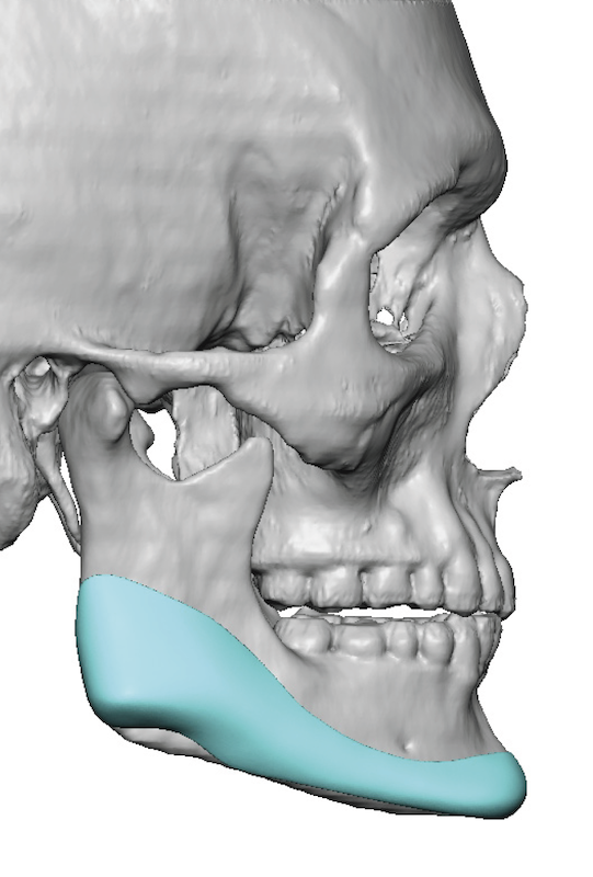 male custom jawline implant design around strong muscle ligament ...