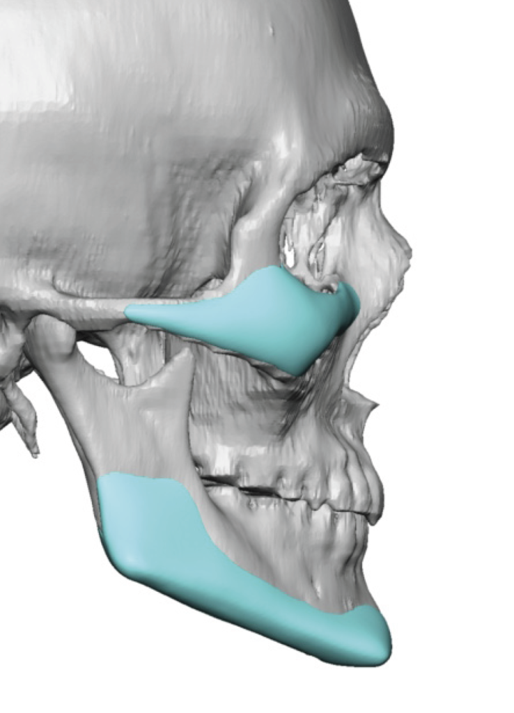 Plastic Surgery Case Study Long Term Results of a Custom Jawline