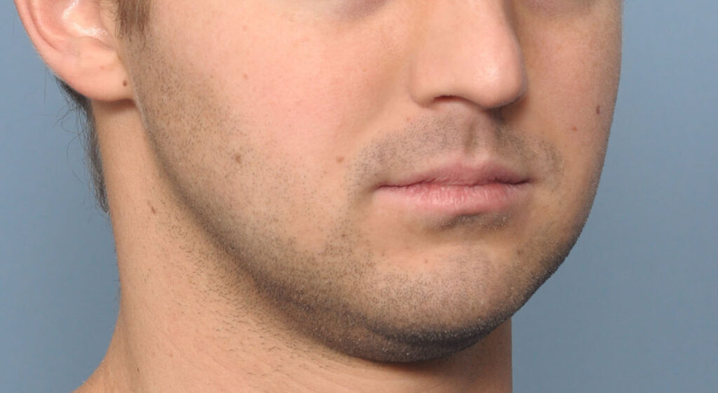 Plastic Surgery Case Study Long Term Results of a Custom Jawline