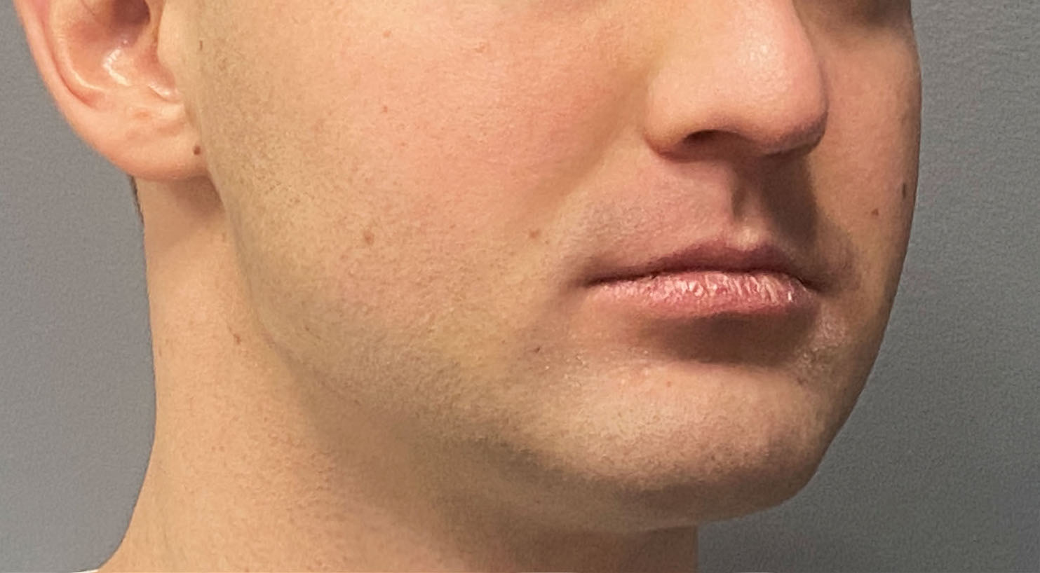 Plastic Surgery Case Study Long Term Results of a Custom Jawline