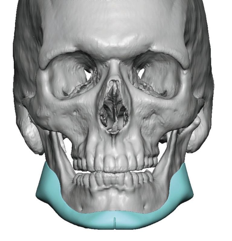 Plastic Surgery Case Study - Custom Jawline Implant Design With 