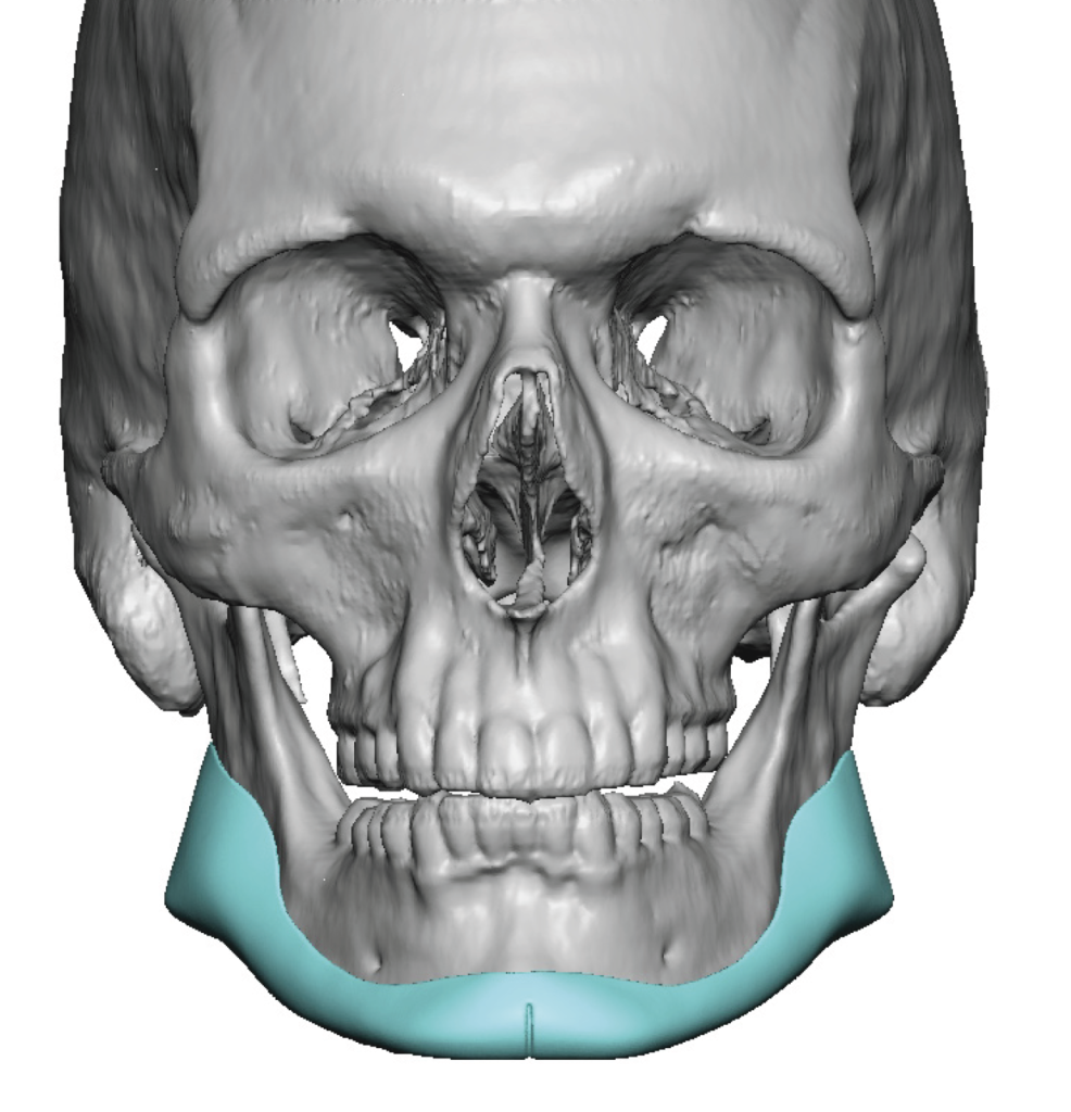 Plastic Surgery Case Study - Custom Jawline Implant Design with ...