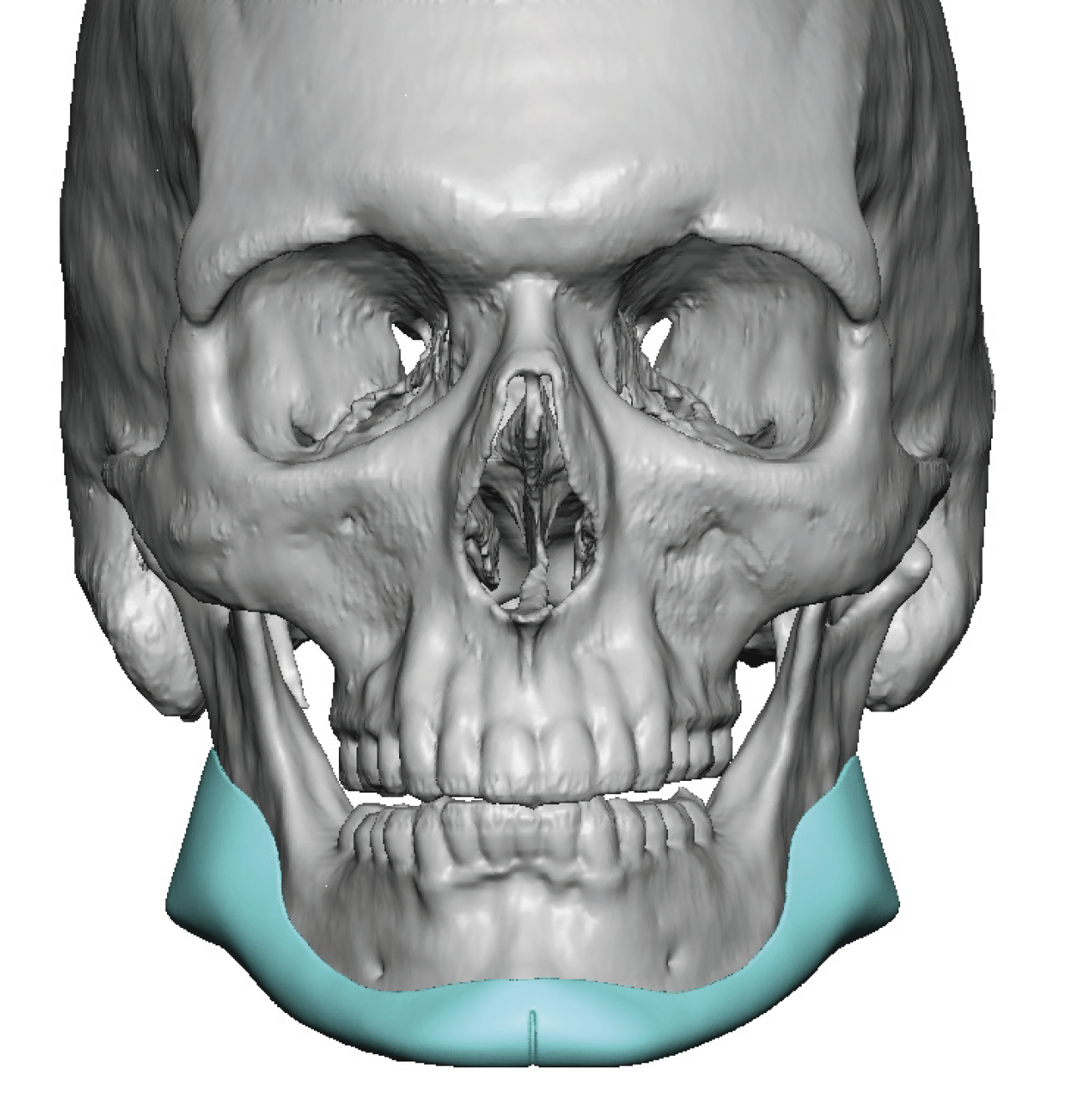 Plastic Surgery Case Study Custom Jawline Implant Design With