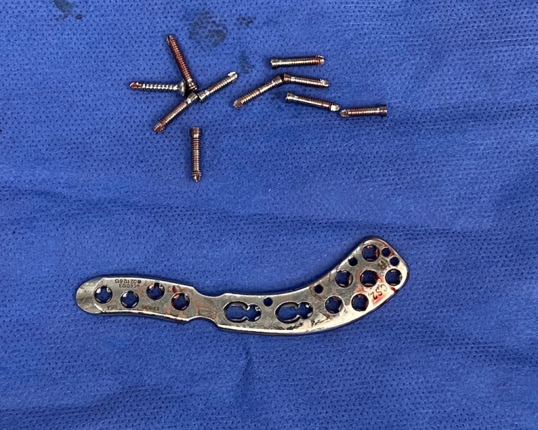 clavicle fracture hardware removal Dr Barry Eppley Explore Plastic