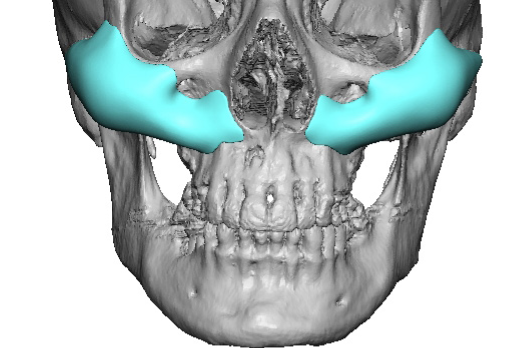 female XL cheek implant designs front view Dr Barry Eppley - Explore ...